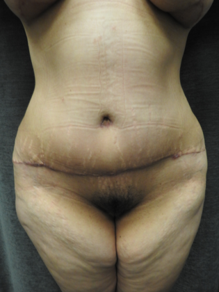 Abdominoplasty Case 16 - San Antonio - After