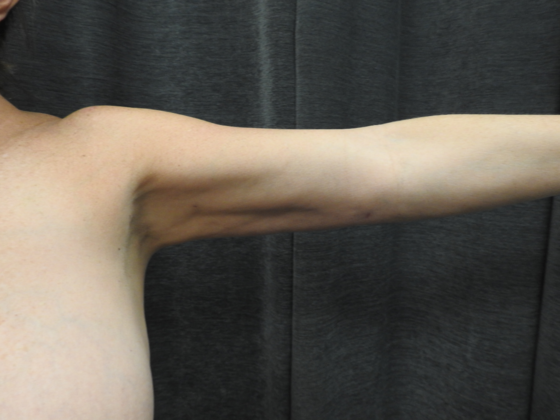 Laser Liposuction: Case 5 - San Antonio - After