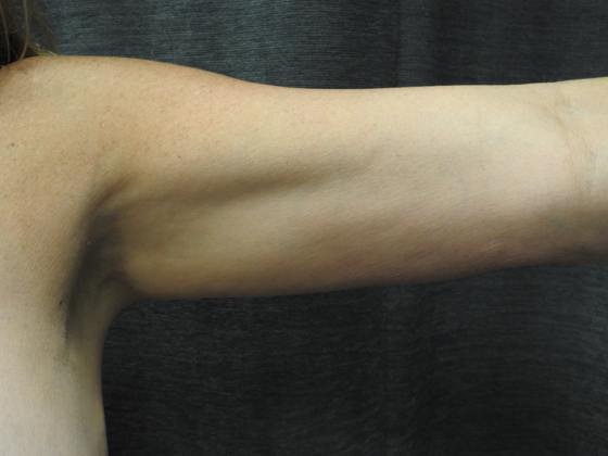 Laser Liposuction: Case 5 - San Antonio - Before