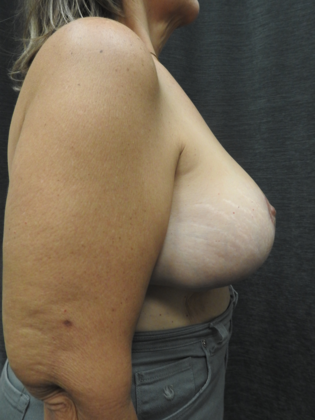 Breast Lift Case 27 - San Antonio - After