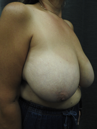 Breast Lift Case 27 - San Antonio - Before