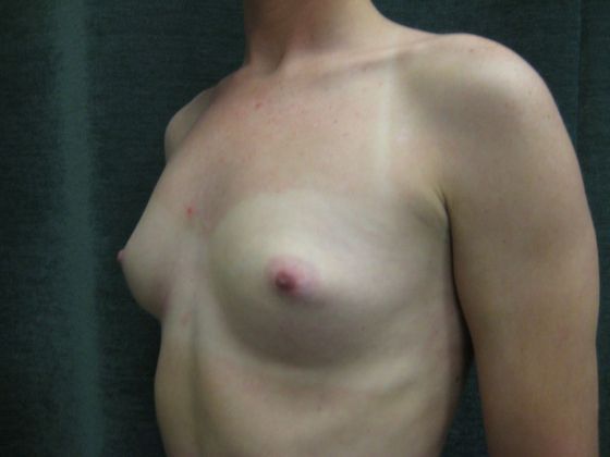 Breast Augmentation: Case 37 - San Antonio - Before