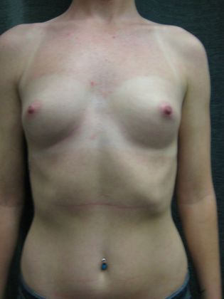 Breast Augmentation: Case 37 - San Antonio - Before