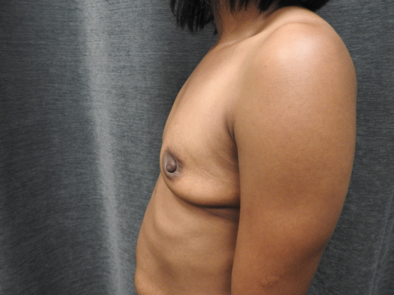 Breast Augmentation: Case 39 - San Antonio - Before