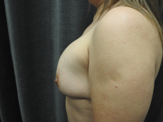 Ideal Implant: Case 29 - San Antonio - Before