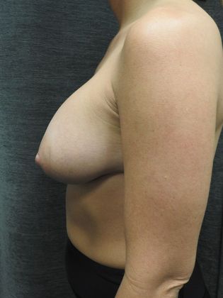 Breast Augmentation: Case 41 - San Antonio - After