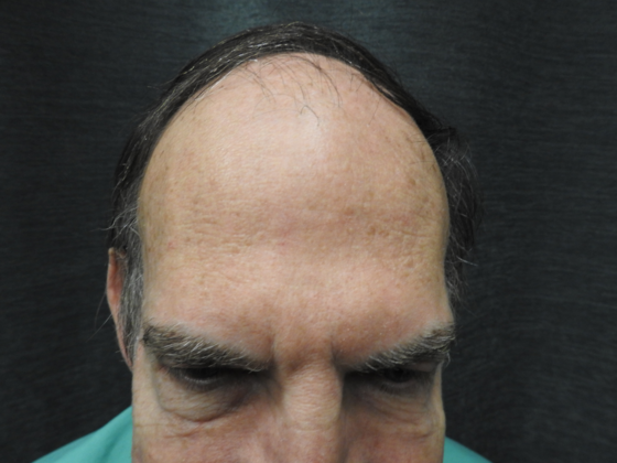 Hair Transplantation Case 1 - Before