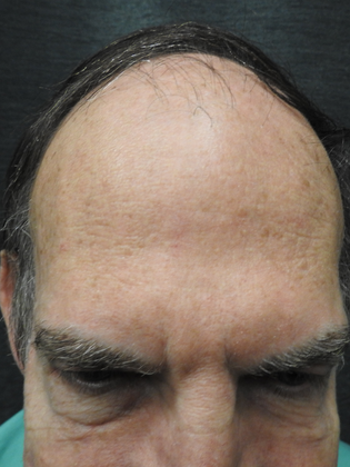 Hair Transplantation Case 1 - Before