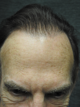 Hair Transplantation Case 1 - After