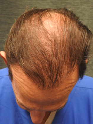 Hair Transplantation: Case 1 - After