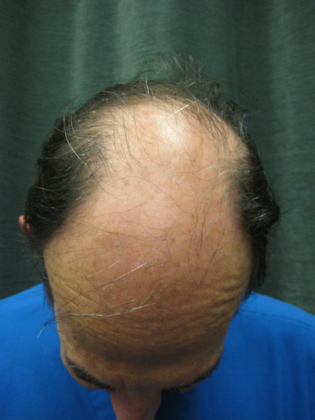 Hair Transplantation: Case 1 - Before