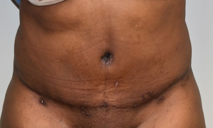Tummy Tuck (Abdominoplasty): Case 188 - After