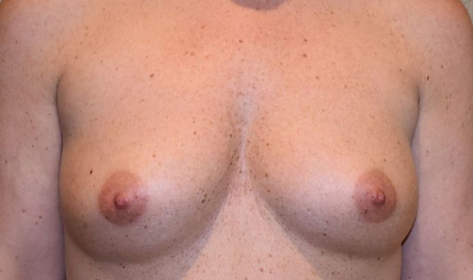 Breast Augmentation w/ Lift Case 262 - Before