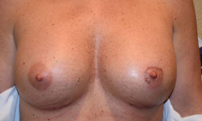 Breast Augmentation w/ Lift Case 262 - After
