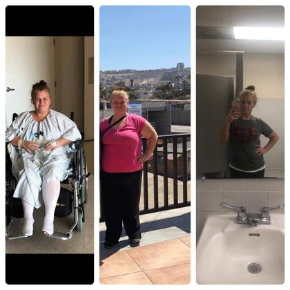 Gastric Sleeve - Click Here to See More! : Case 30 - Before & After