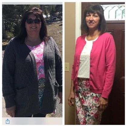Gastric Sleeve - Click Here to See More! : Case 32 - Before & After