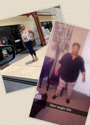 Gastric Sleeve - Click Here to See More! : Case 35 - Before & After