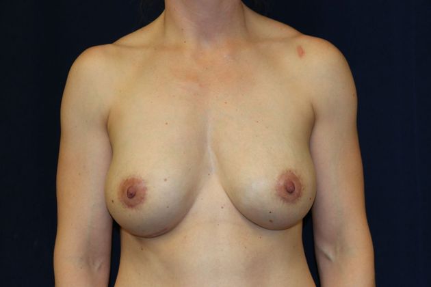 Breast Implant Removal and Exchange Case 8 - After
