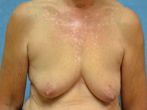 Breast Augmentation Case 1365- Weston, OH - Before