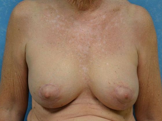 Breast Augmentation Case 1365- Weston, OH - After