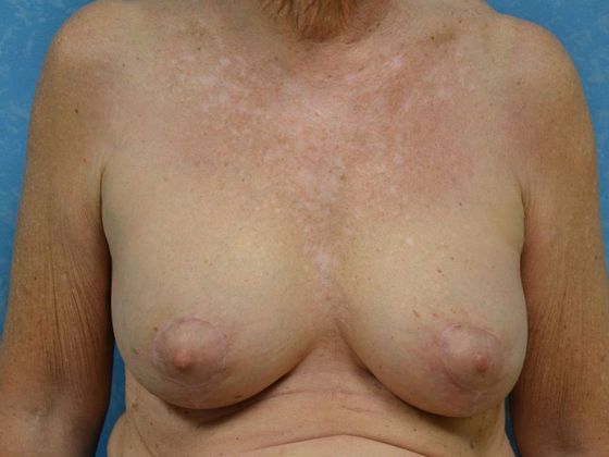 Breast Lift Case 1363- Weston, OH - After