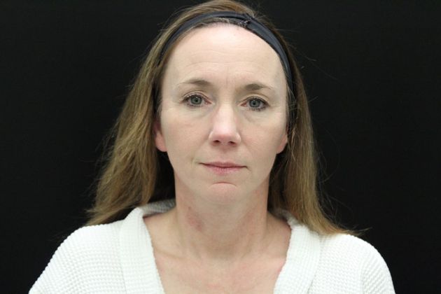 Face & Neck Lifts Case 15 - After