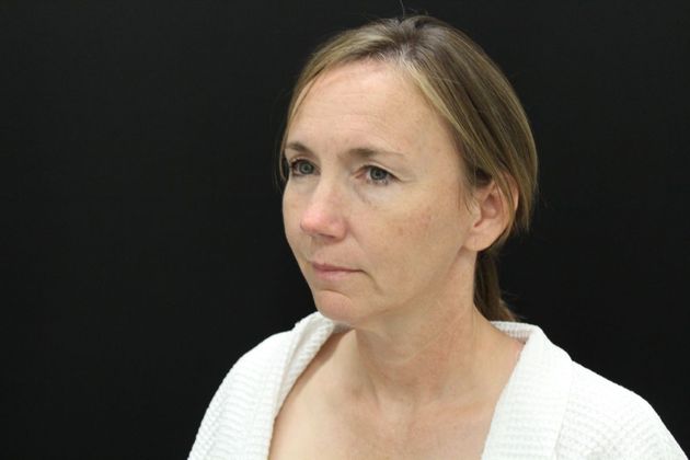 Face & Neck Lifts: Case 15 - Before