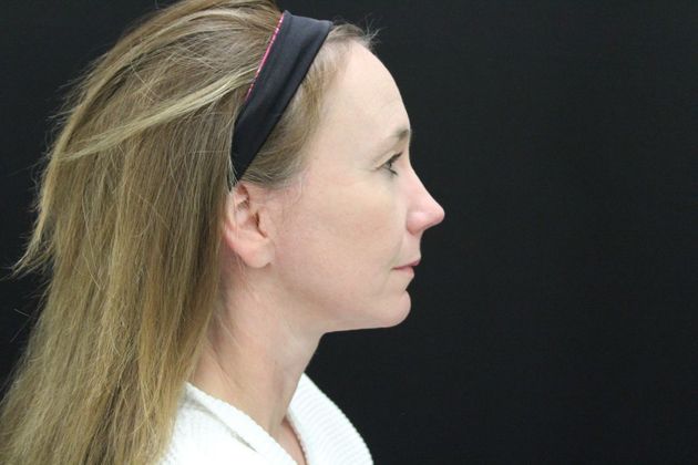 Face & Neck Lifts: Case 15 - After