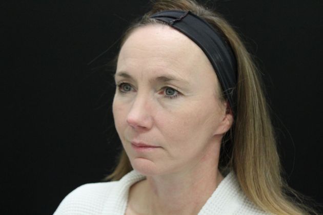 Face & Neck Lifts: Case 15 - After