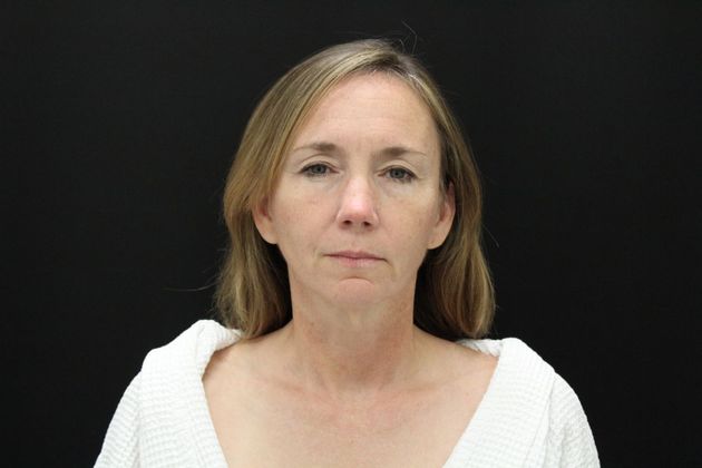 Face & Neck Lifts Case 15 - Before