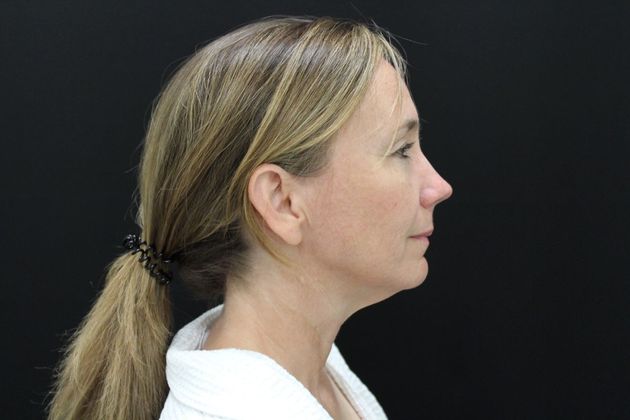 Face & Neck Lifts: Case 15 - Before