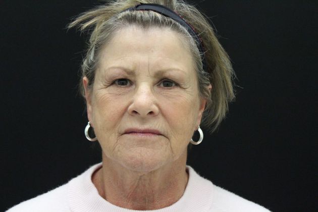 Face & Neck Lifts: Case 18 - Before