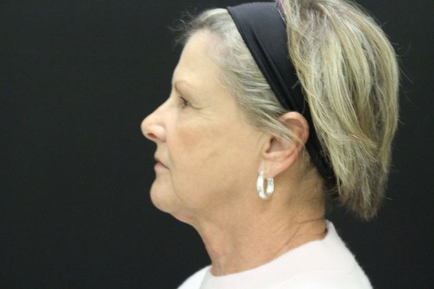 Face & Neck Lifts: Case 18 - Before