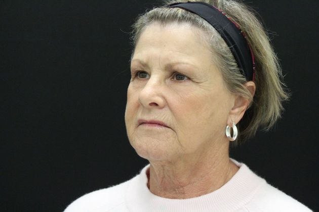 Face & Neck Lifts: Case 18 - Before
