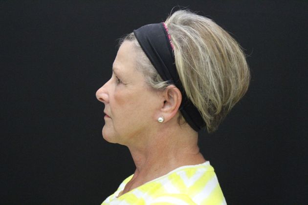 Face & Neck Lifts: Case 18 - After