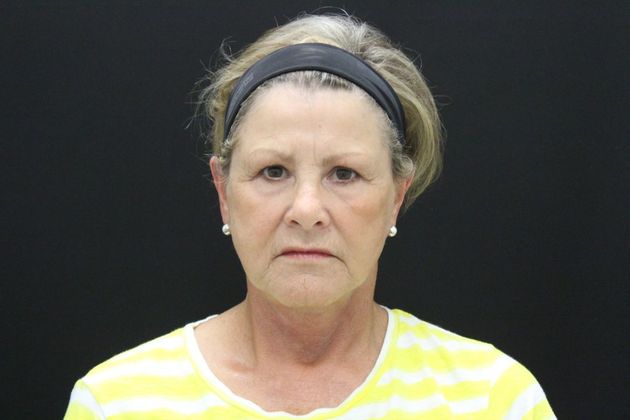 Face & Neck Lifts: Case 18 - After