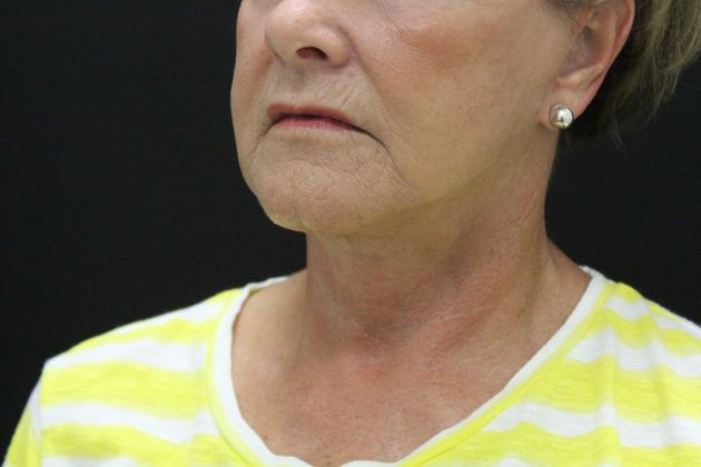 Face & Neck Lifts: Case 18 - After
