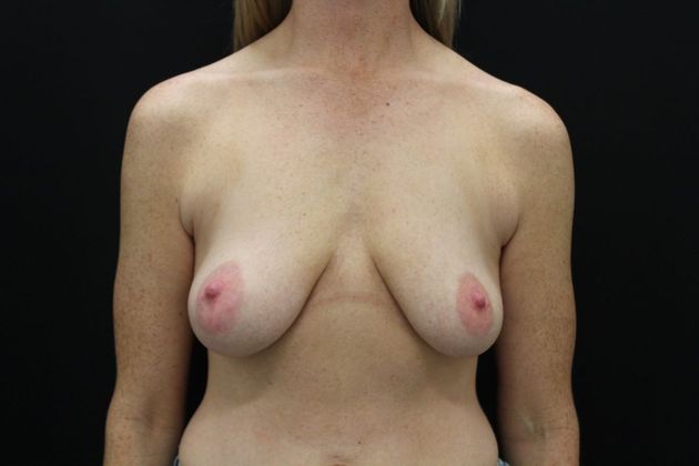Breast Lift/Breast Lift Augmentation Case 26 - Before