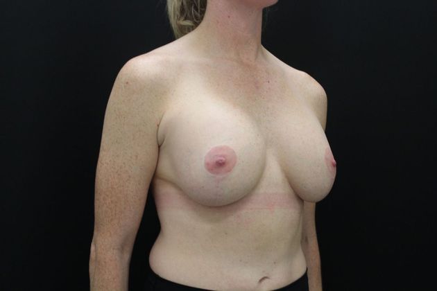 Breast Lift/Breast Lift Augmentation: Case 26 - After