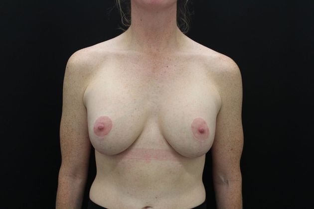 Breast Lift/Breast Lift Augmentation Case 26 - After