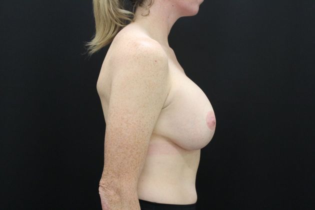Breast Lift/Breast Lift Augmentation: Case 26 - After