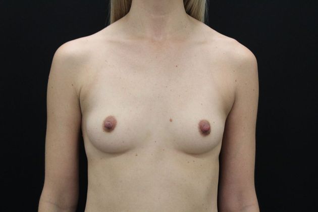 Breast Augmentation Case 9 - Before