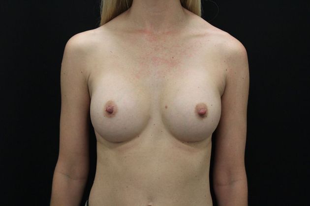 Breast Augmentation Case 9 - After