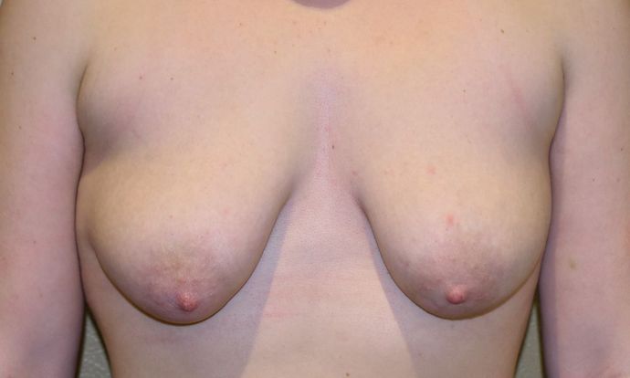 Breast Augmentation w/ Lift Case 263 - Before