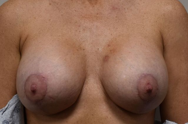 Breast Augmentation w/ Lift Case 264 - After