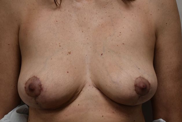 Breast Revision: Case 112 - After