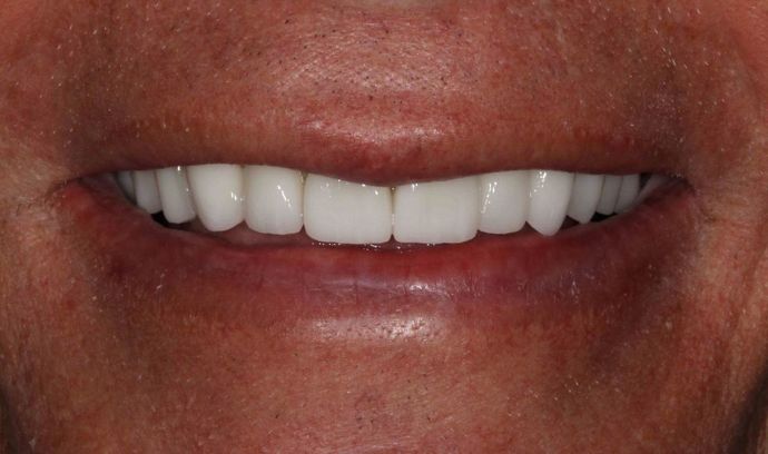 Dental Implants Case 2 - After
