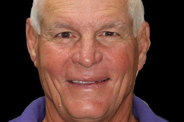 Smile Makeover Case 1 - Before