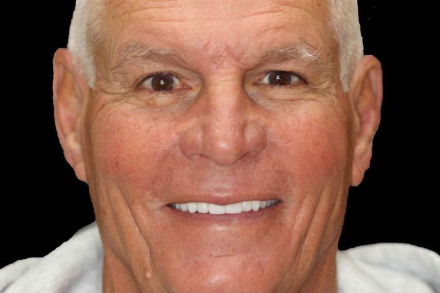 Smile Makeover Case 1 - After