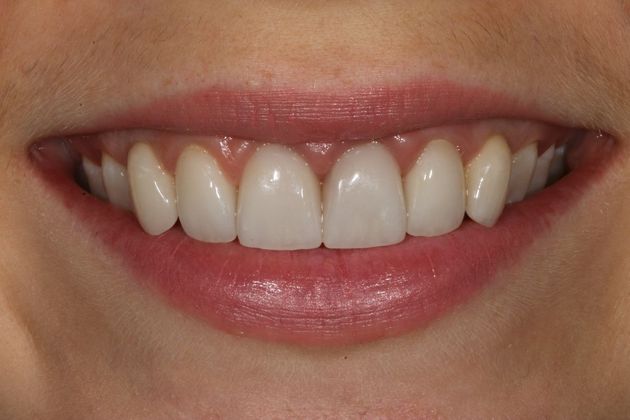 Cosmetic Dentistry Case 3 - After